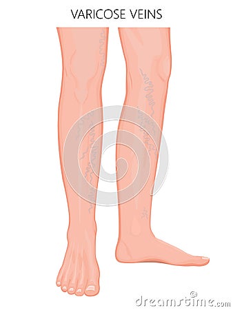 Bone fracture_Varicose veins Vector Illustration