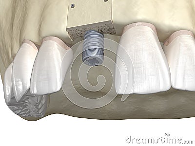 Bone grafting- augmentation using block of bone, tooth implantation. Medically accurate 3D illustration Cartoon Illustration