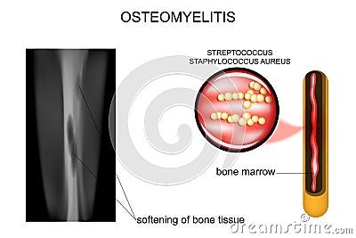 Bone lesions osteomyelitis Vector Illustration