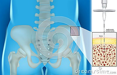 Bone Marrow Aspiration And Biopsy. Illustration of the Needle extends into bone marrow. Vector Illustration