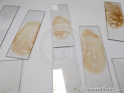 Bone marrow study. Microscopic glass slide smear Stock Photo