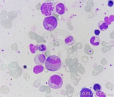 Bone marrow study: dimorphic Erythroid hyperplasia Stock Photo