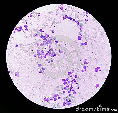 Bone marrow study: Suggestive of reactive marrow with dimorphic Erythroid hyperplasia Stock Photo