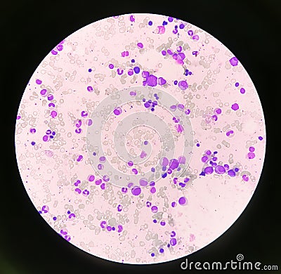 Bone marrow study: Suggestive of reactive marrow with dimorphic Erythroid hyperplasia Stock Photo