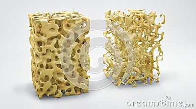 Bone structure, normal and with osteoporosis Cartoon Illustration