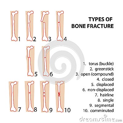Bones fractures Vector Illustration