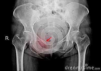 Hip x-ray Fracture right superior pubic ramus.Normal both hips Stock Photo