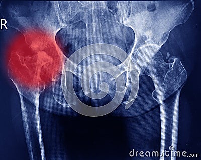 Both hips joint x-ray showing destruction head right femur and erosion acetabulum with widening right hip joint from chronic Stock Photo