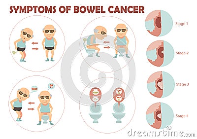 Bowel cancer Vector Illustration