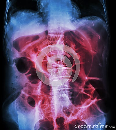 Bowel Obstruction ( X-ray abdomen supine position : large bowel Stock Photo