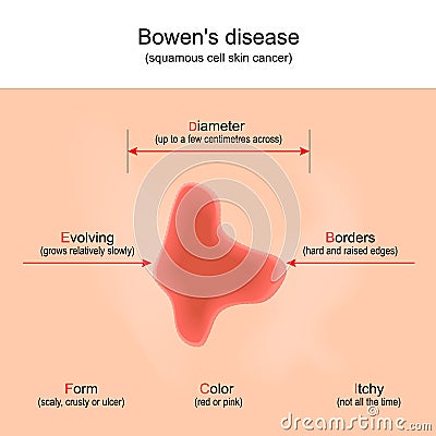 Bowen`s disease. squamous cell skin cancer. Vector Illustration