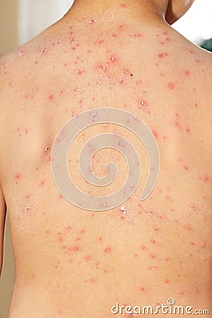 Boy with chicken pox Stock Photo