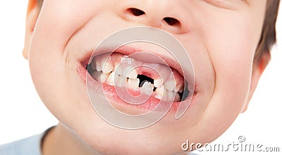 Boy face closeup with a lost tooth Stock Photo