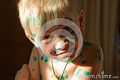 Boy with green dots of chickenpox Stock Photo