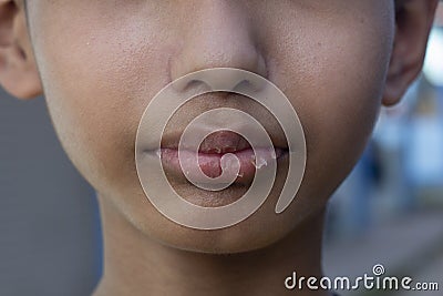 A boy is lips skin detachment and cracked due to cold weather in winter and lack of water in the body. Stock Photo