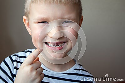 Boy missing milk teeth Stock Photo