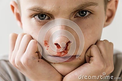 Boy with Nose Bleed Resting Chin on Hands Stock Photo