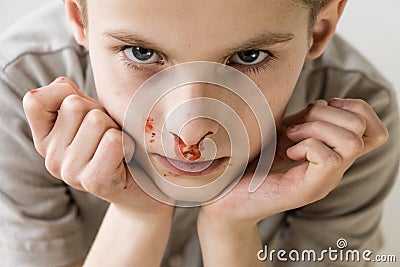 Boy with Nose Bleed Staring Up at Camera Stock Photo