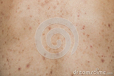 Boy with problematic skin and acne scars in the back Stock Photo