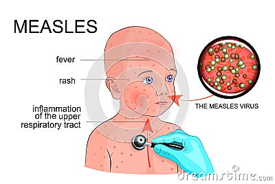 The boy with the symptoms of rubella or measles Vector Illustration