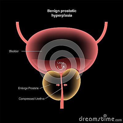 BPH info concept Vector Illustration