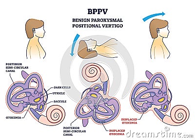 BPPV or benign paroxysmal positional vertigo syndrome outline diagram Vector Illustration