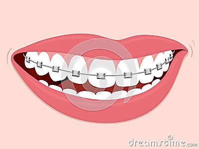 Braces Corrective Orthodontics Vector Illustration