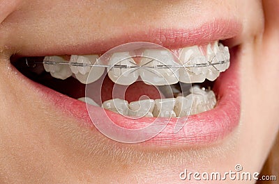 Braces on teeth Stock Photo