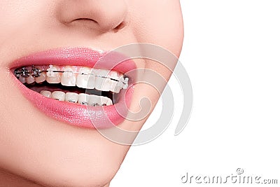 Braces on Teeth. Dental Braces Smile. Orthodontic Treatment. Stock Photo