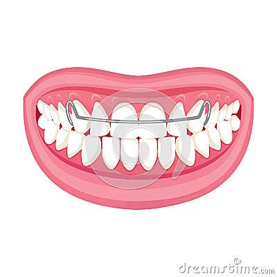 Braces on teeth. pink lips white teeth. Stock Photo