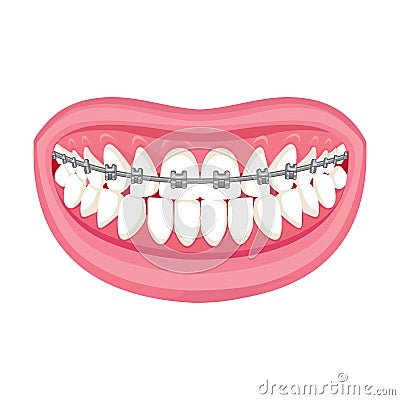 Braces on teeth. pink lips white teeth. Stock Photo