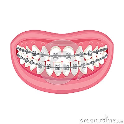 Braces on teeth. pink lips white teeth. Stock Photo