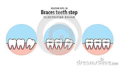 Braces teeth step in circle illustration vector on white Vector Illustration