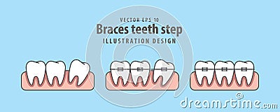 Braces teeth step illustration vector on blue background. Dental Vector Illustration