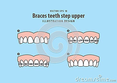 Braces teeth step upper illustration vector on blue background. Vector Illustration