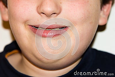 Braces and white teeth of smile Stock Photo