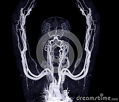 Brachial Arteries of the arm with Upper extremity Bone 3D rendering from CT Scanner Stock Photo