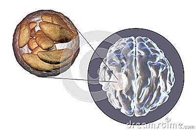 Brain abscess caused by parasitic protozoan Toxoplasma gondii Cartoon Illustration