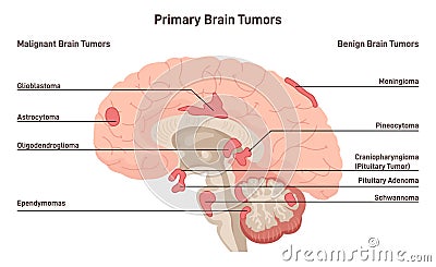 Brain cancer concept. Primary brain tumors types. Malignant cells develop Vector Illustration