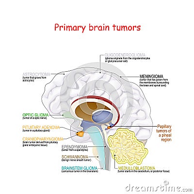 Brain cancer. different types of primary brain tumors Vector Illustration