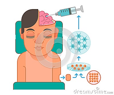Brain cells transplantation concept illustration Vector Illustration
