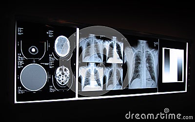 Brain and Chest X-ray on a Light Board Stock Photo