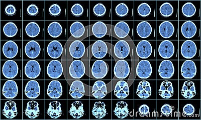 Brain CT Scan Stock Photo