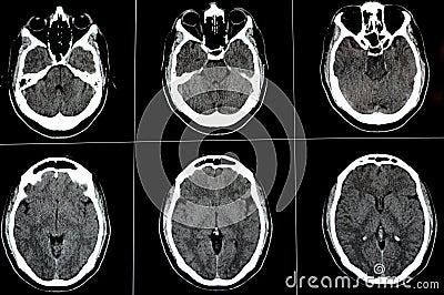 Brain CT scan showing brainstem cavernoma, right centrum semiovale developmental venous anomaly, intra cerebral haematoma, faint Stock Photo