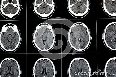 Brain CT scan showing brainstem cavernoma, right centrum semiovale developmental venous anomaly, intra cerebral haematoma, faint Stock Photo