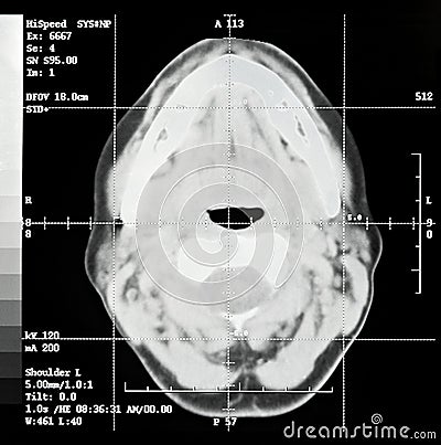 Brain CT Slice Stock Photo