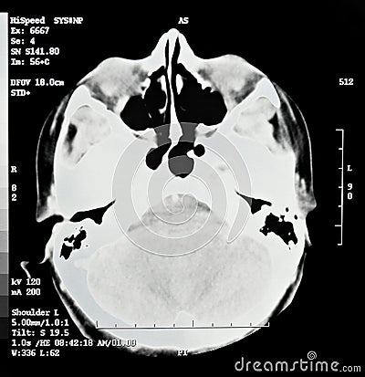 Brain CT View Stock Photo