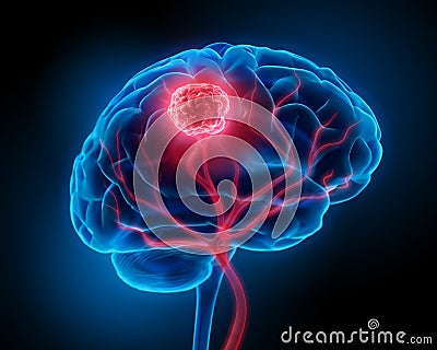 Brain with tumor - x ray 3D illustration Cartoon Illustration