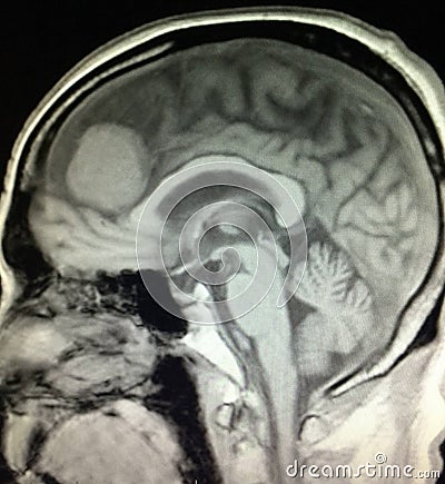 Brain meningioma headache mri examination Stock Photo