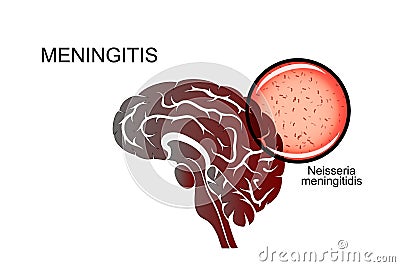 Brain, meningitis, the causative agent of meningitis Vector Illustration